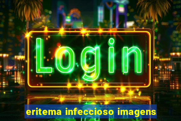 eritema infeccioso imagens